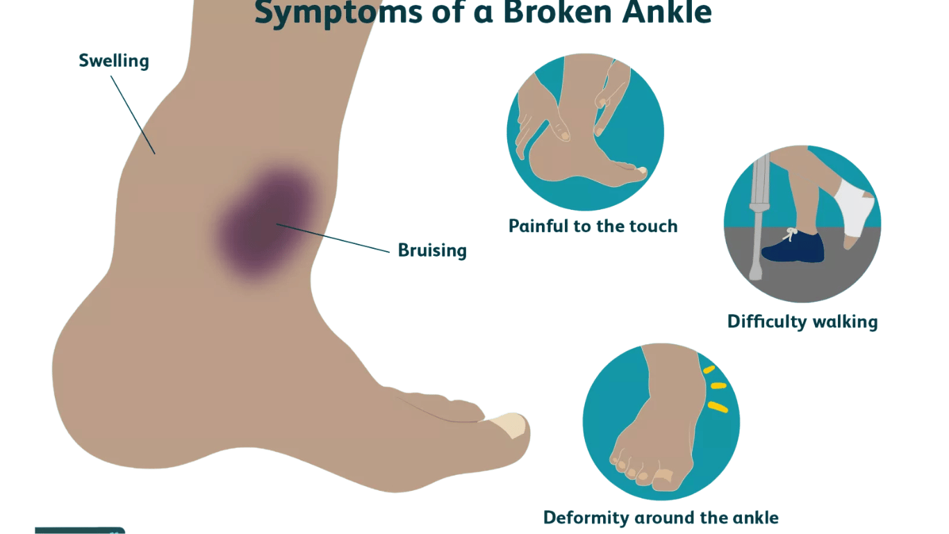 Understanding Broken Ankle Symptoms and Causes