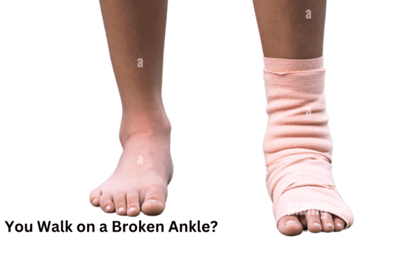 Can You Walk on a Broken Ankle?