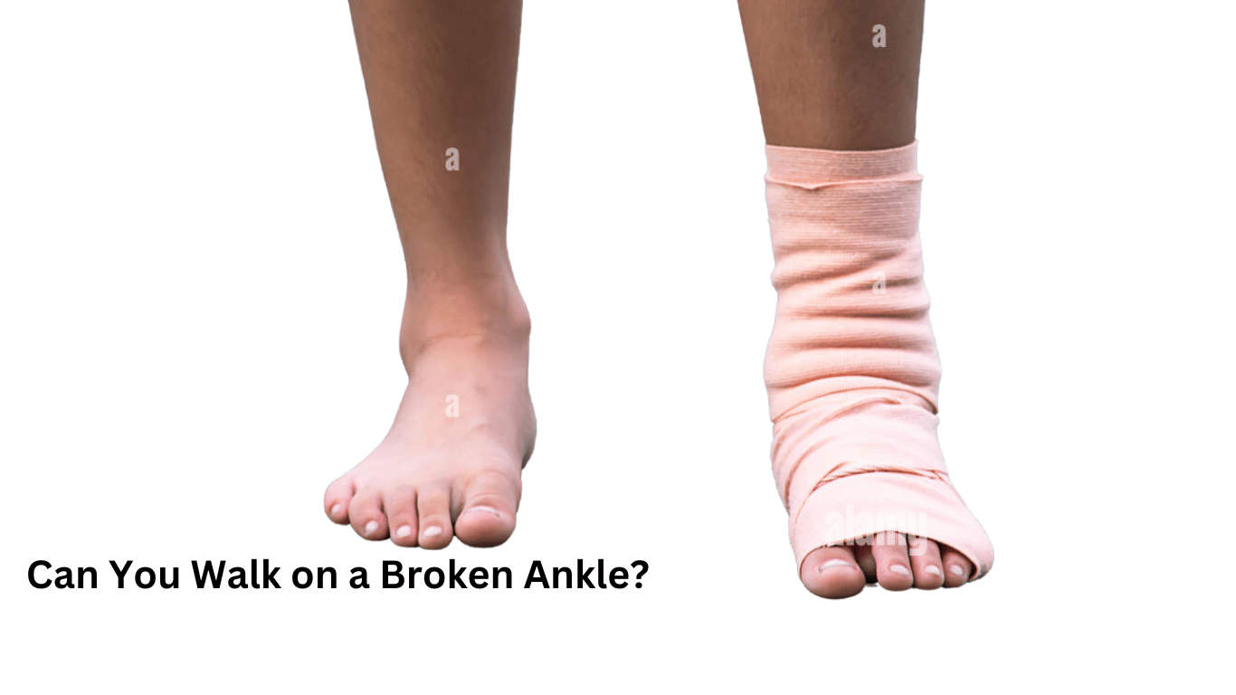 Can You Walk on a Broken Ankle?